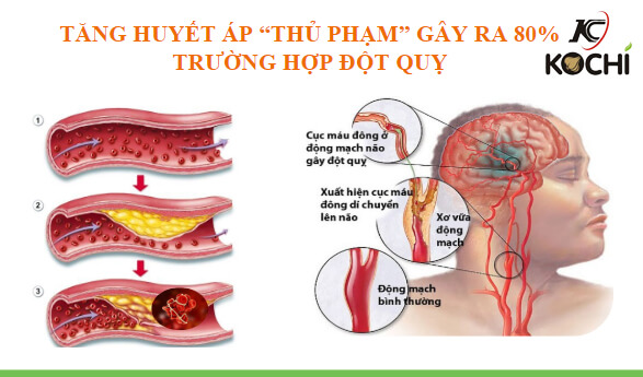 Tăng huyết áp thủ phạm gây đột quỵ não