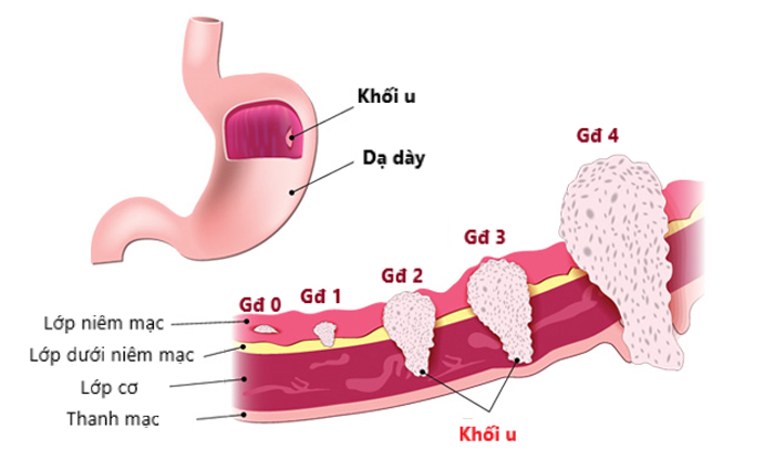 Các giai đoạn phát triển ung thư dạ dày