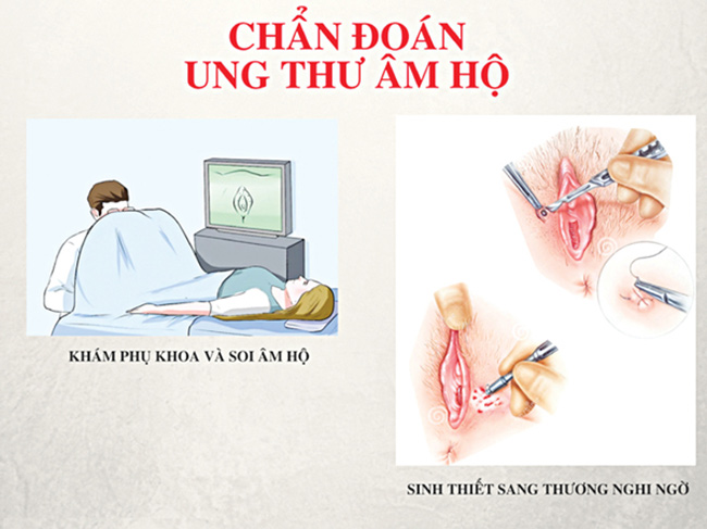 Chấn đoán ung thư âm đạo