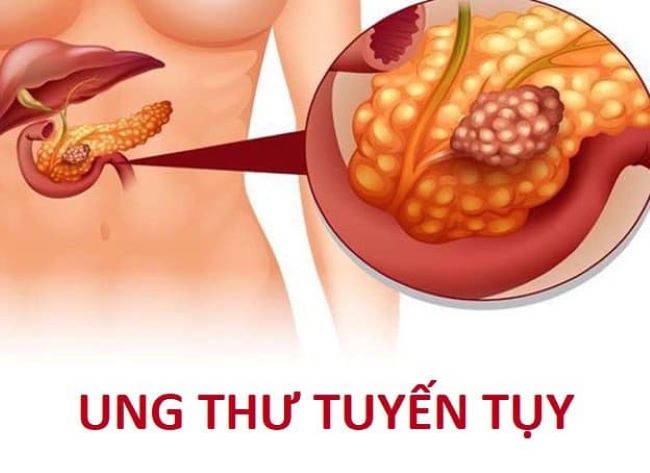 phân loại ung thư tuyến tụy