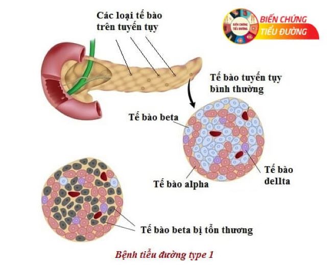 Tiểu đường tuýp 1 là gì? 