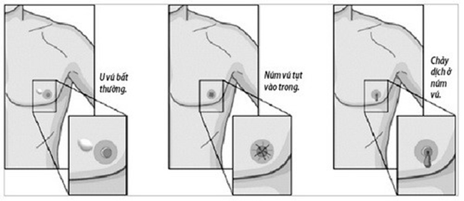 Triệu chứng ung thư vú ở nam giới