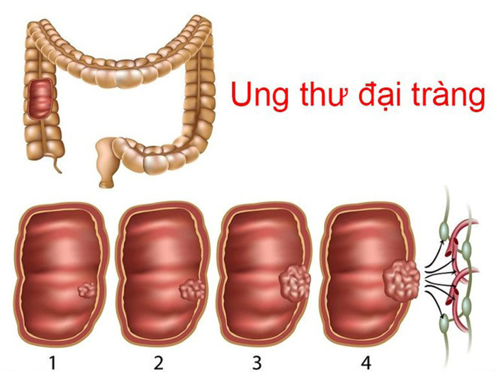 Các giai đoạn của ung thư đại tràng