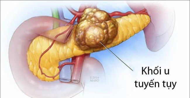 ung thư tuyến tụy là gì?