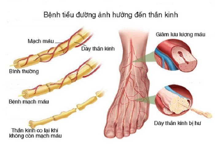 Biến chứng của bệnh tiểu đường đối với trung tâm thần kinh