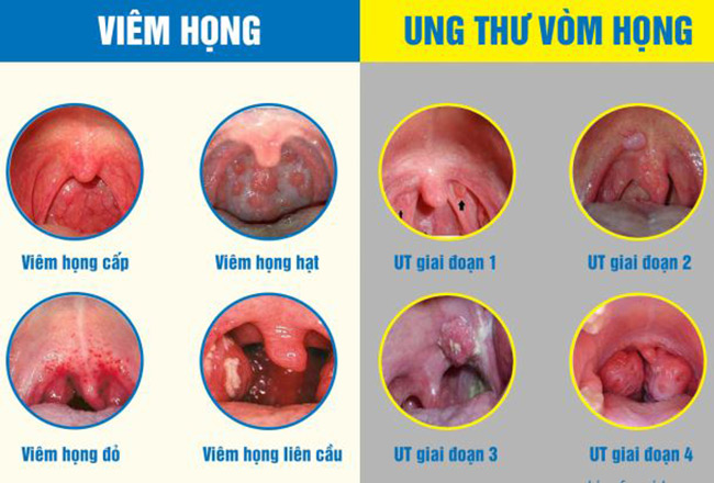 Phân biệt viêm họng và ung thư vòm họng