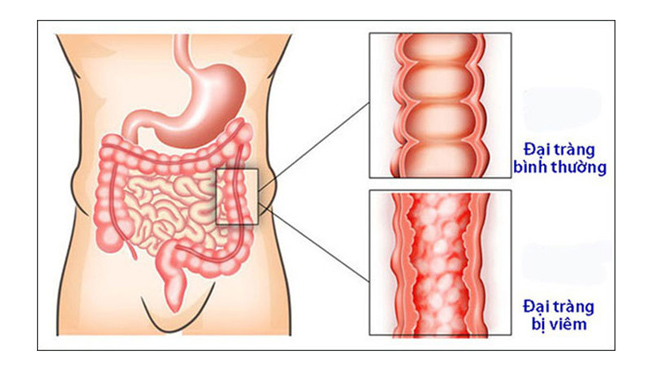 Bệnh đại tràng có nguyên nhân từ đâu?