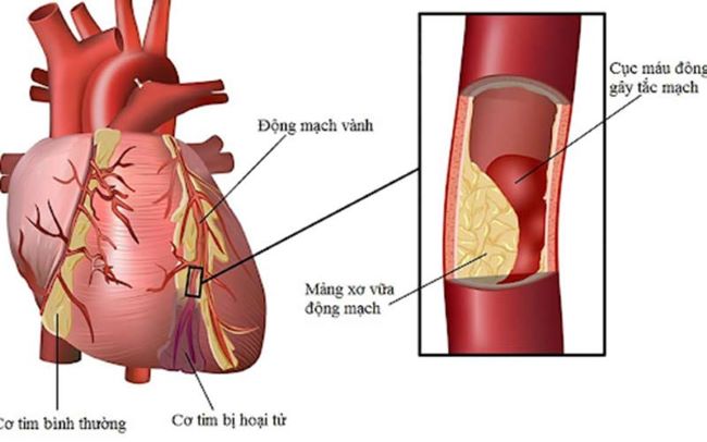 Bệnh máu nhiễm mỡ là gì?