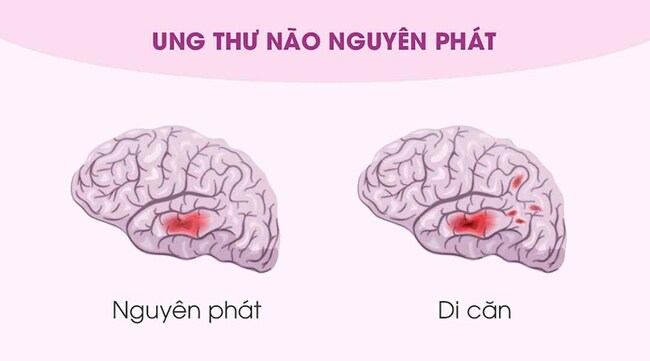 các dạng ung thư não sẽ có triệu chứng ung thư não khác nhau