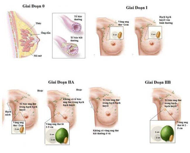 Các giai đoạn ung thư vú.