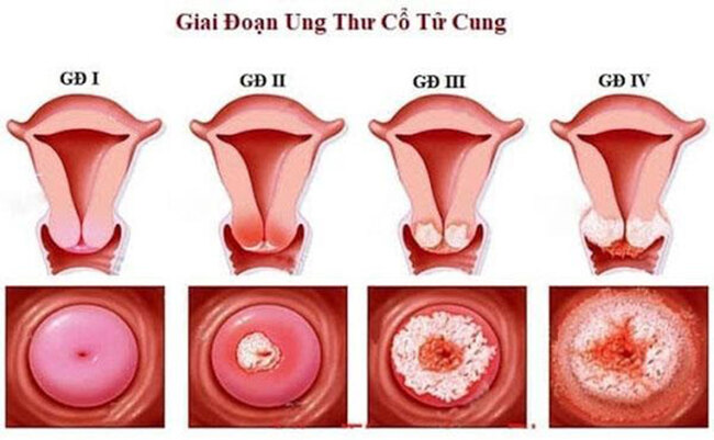 các giai đoạn ung thư cổ tử cung