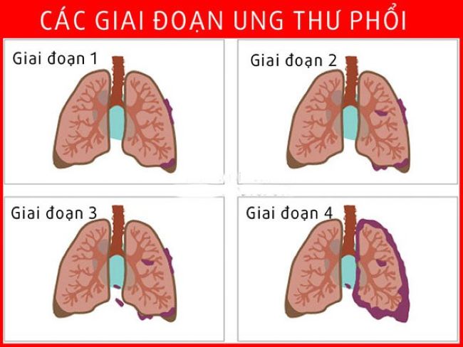 Các giai đoạn ung thư phổi