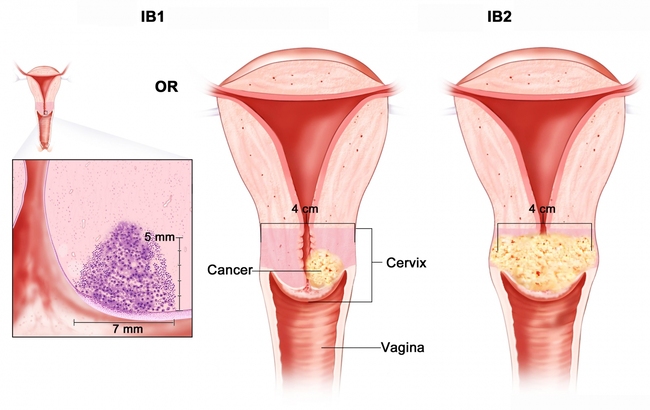 giai đoạn ung thư cổ tử cung I là giai đoạn sớm