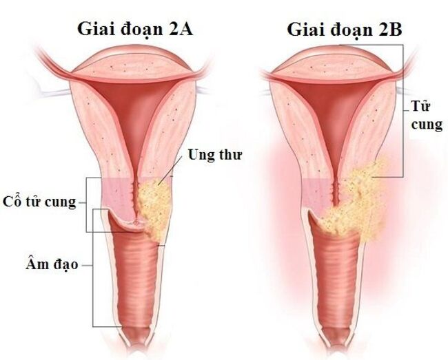 giai đoạn ung thư cổ tử cung II khối u đã lớn hơn