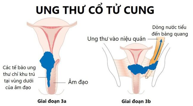 giai đoạn ung thư cổ tử cung III khối u phát triển nhanh nhất