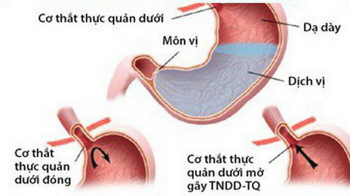 Rối loạn cơ thắt thực quản dưới là nguyên nhân trào ngược dạ dày