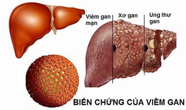 nguyên nhân ung thư gan và các biến chứng viêm gan