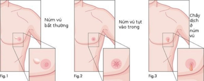 Núm vú, thụt vào trong khi mắc ung thư vú nam.