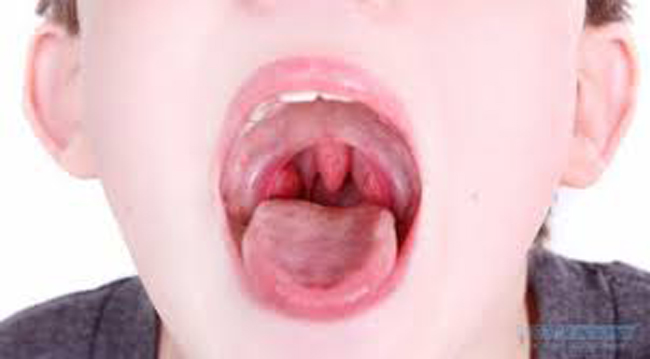 Thăm khám ung thư cổ họng