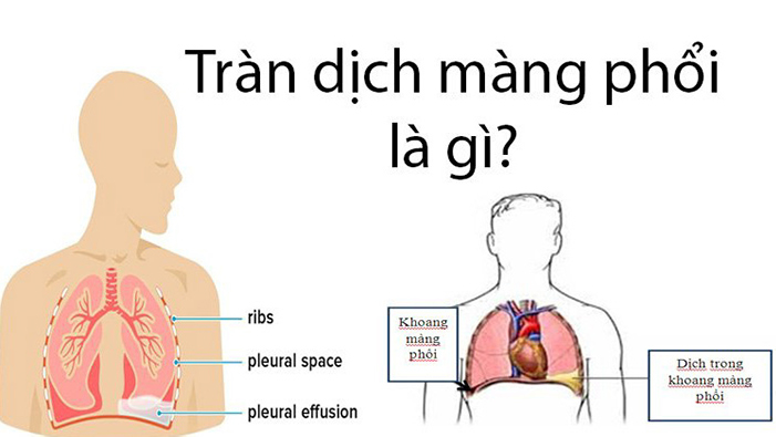 Tràn dịch màng phổi là gì ?