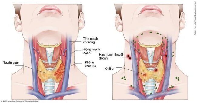 triệu chứng bệnh ung thư vòm họng