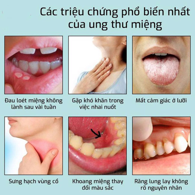 Triệu chứng của ung thư khoang miệng