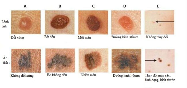 triệu chứng ung thư da giữa u lành với u ác