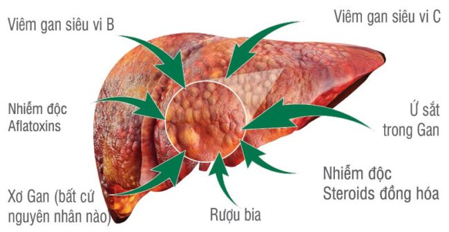 triệu chứng ung thư gan và nguyên nhân ung thư gan