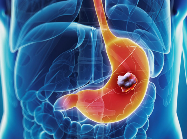 nguyên nhân gây ung thư dạ dày