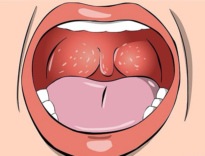 ung thư khoang miệng