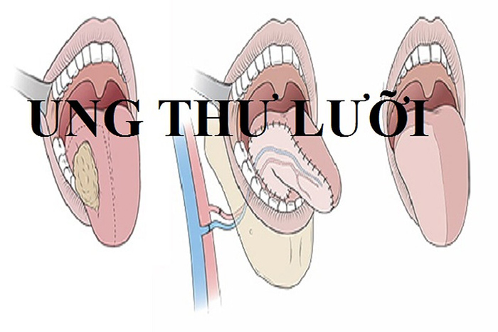 ung thư lưỡi
