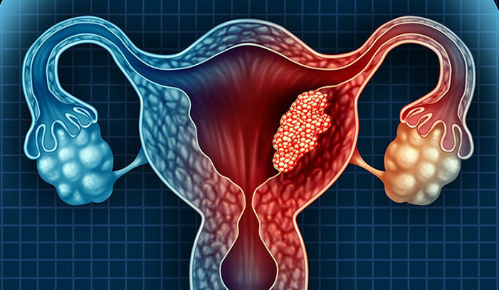 ung thư nội mạc tử cung