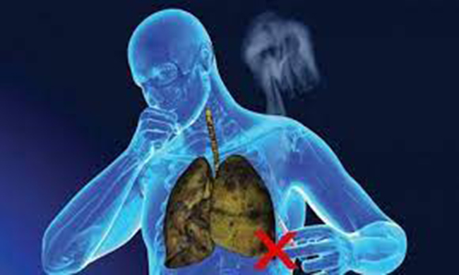 Ung thư phổi do hút thuốc lá là bệnh phổ biến ở phổi