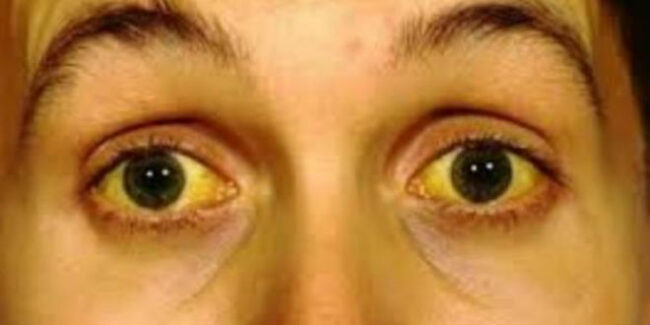 Bệnh nhân ung thư gan di căn có biểu hiện vàng da, vàng mắt