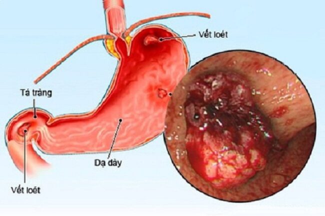 viêm dạ dày mạn là nguyên nhân gây ung thư dạ dày