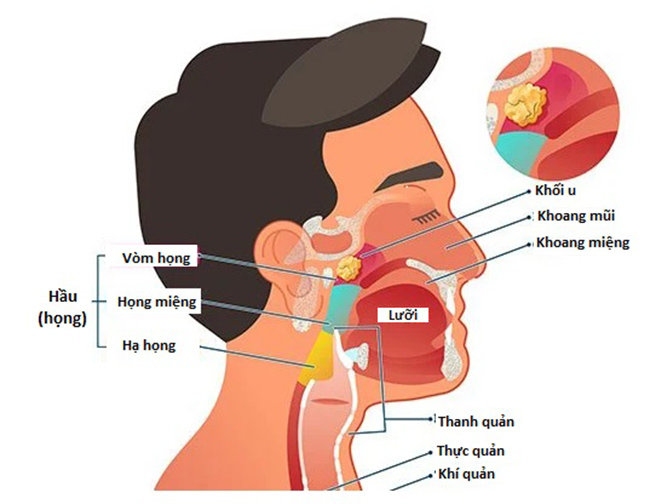 Vị trí thường gặp ung thư vòm họng