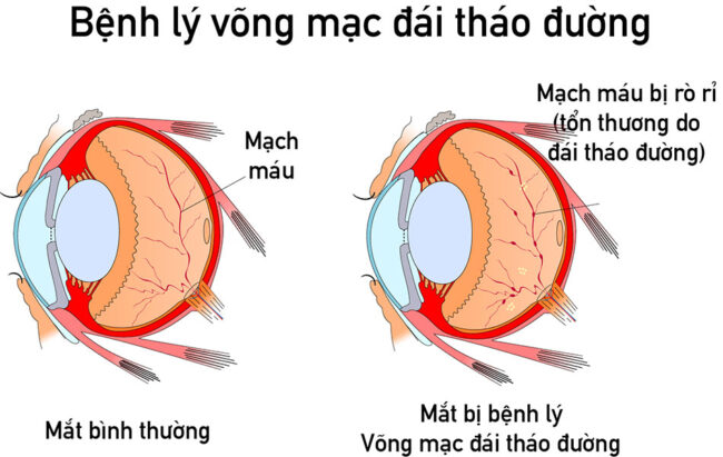 võng mạc đái tháo đường là 1 biến chứng tiểu đường