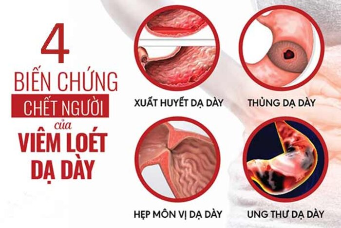 Biến chứng nguy hiểm của loét dạ dày - tá tràng