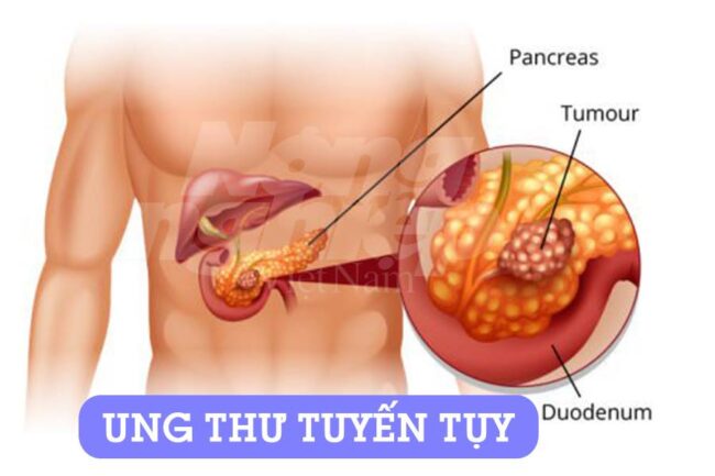 Biểu hiện ung thư tuyến tụy là gì