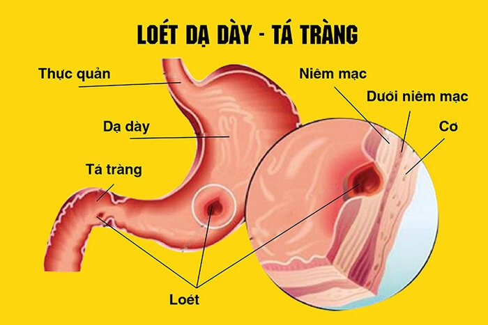 loét dạ dày tá tràng