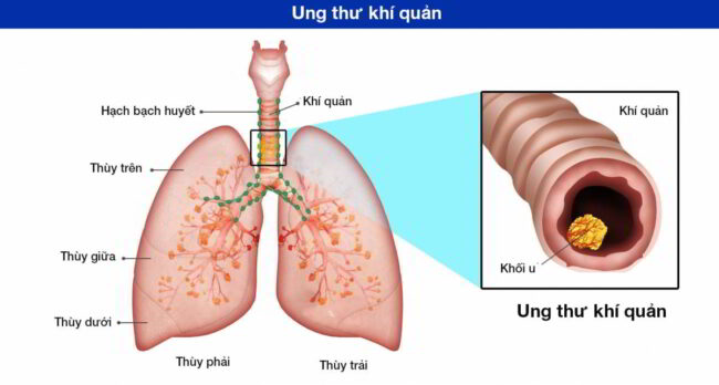 Ung thư khí quản