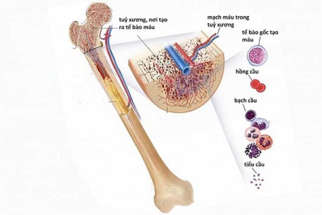 Suy tủy xương, thiếu máu không đủ điều kiện tiếp tục điều trị là tác dụng phụ của hóa trị