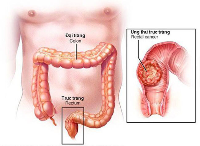 Ung thư trực tràng là căn bệnh gây tỷ lệ tử vong cao 