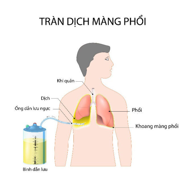 tràn dịch màng phổi